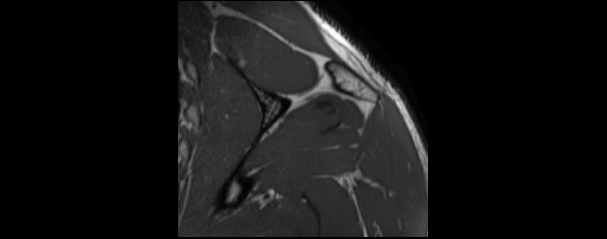shoulder ligments coronal  cross sectional anatomy 3T MRI AI enhanced radiology image -img-00001-00040.webp